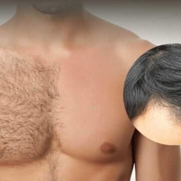 Body Hair Transplant